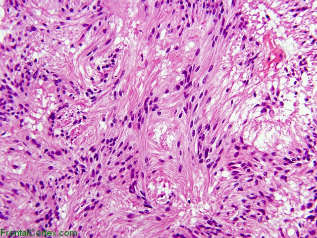 Myxopapillary ependymoma,  H&E stain x200